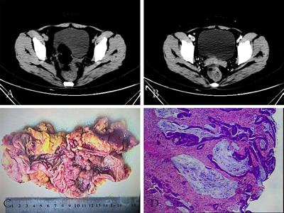 Case Report: Long-term survival of a patient with advanced rectal cancer and multiple pelvic recurrences after seven surgeries